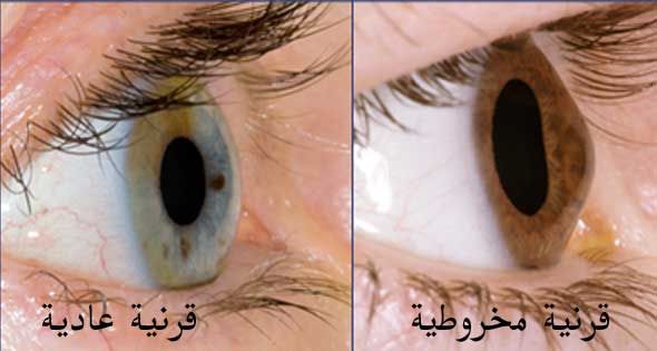 عمليات تثبيت القرنية