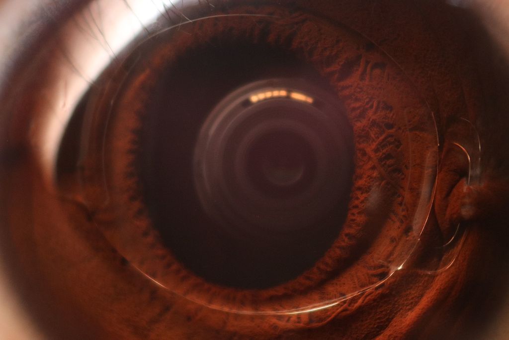 عملية زراعة عدسات Implantable Collamer Lens (ICL)