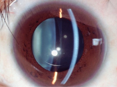 عملية زراعة القرنية Penetrating Keratoplasty (PKP)