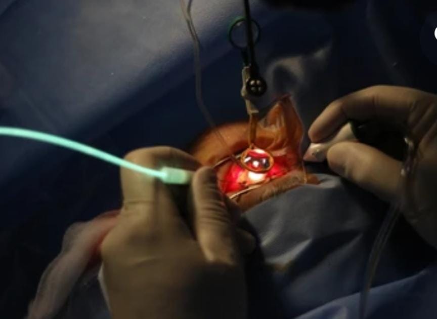 عملية قص السائل الزجاجي (انفصال الشبكية) Vitrectomy